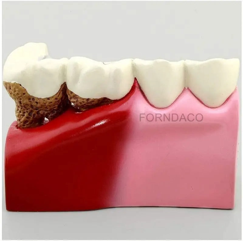 Modelo de Ensino de Anatomia Dentária – Cárie Oral