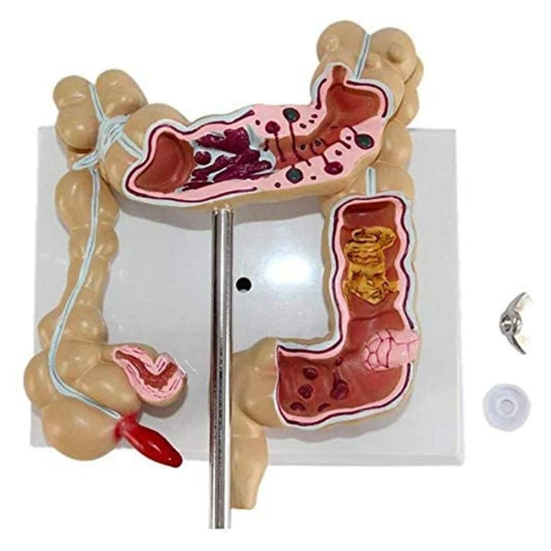 Modelo do Intestino Grande Patológico do Cólon - Câncer Colorretal