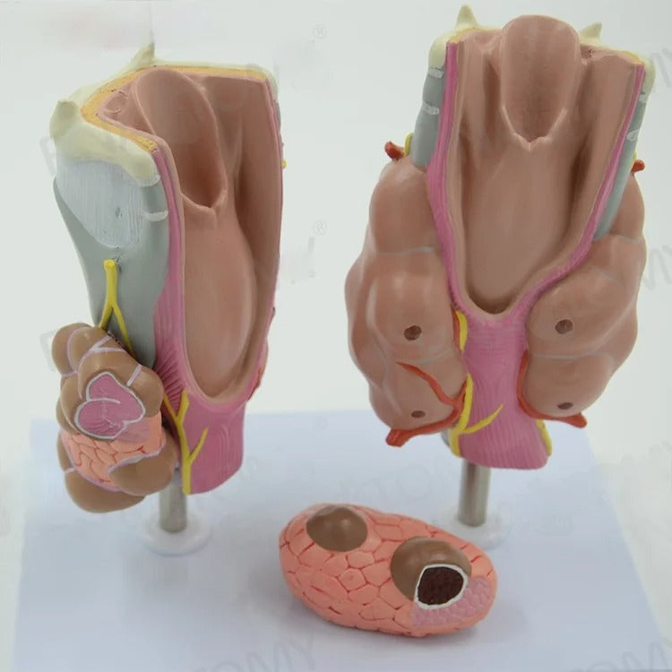 Modelo Anatômico Patologia da Tireóide: Hipertireoidismo