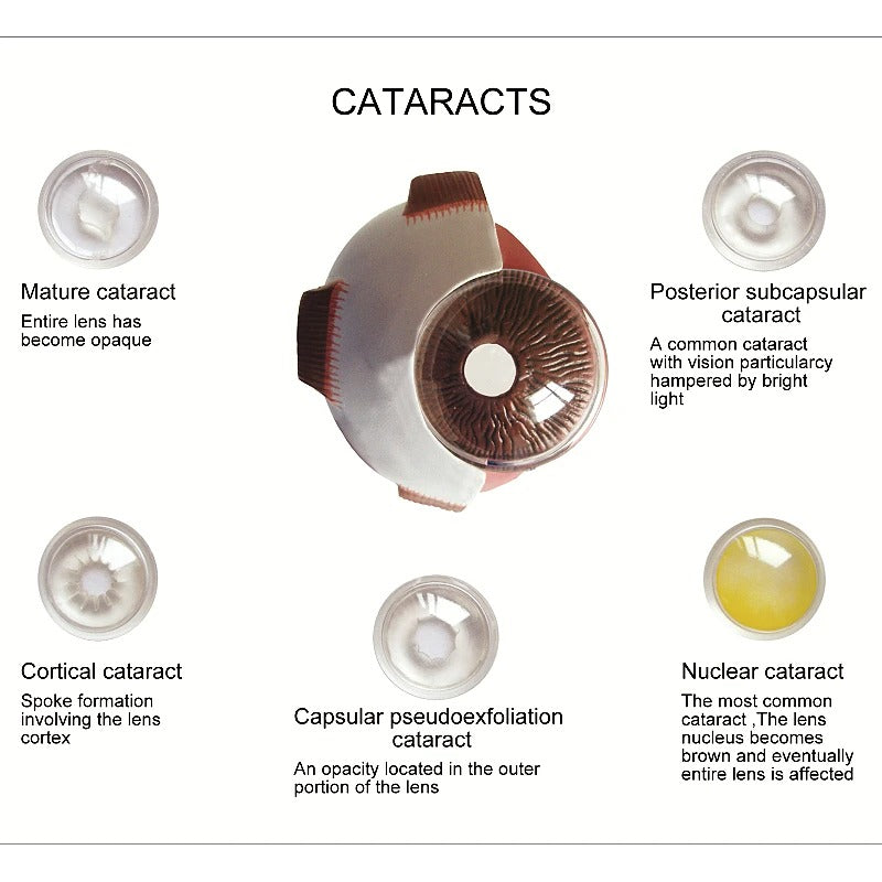 Modelo anatomico olho catarata