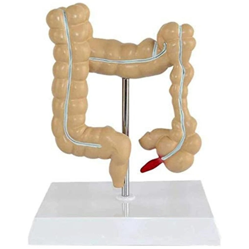 Modelo do Intestino Grande Patológico do Cólon - Câncer Colorretal
