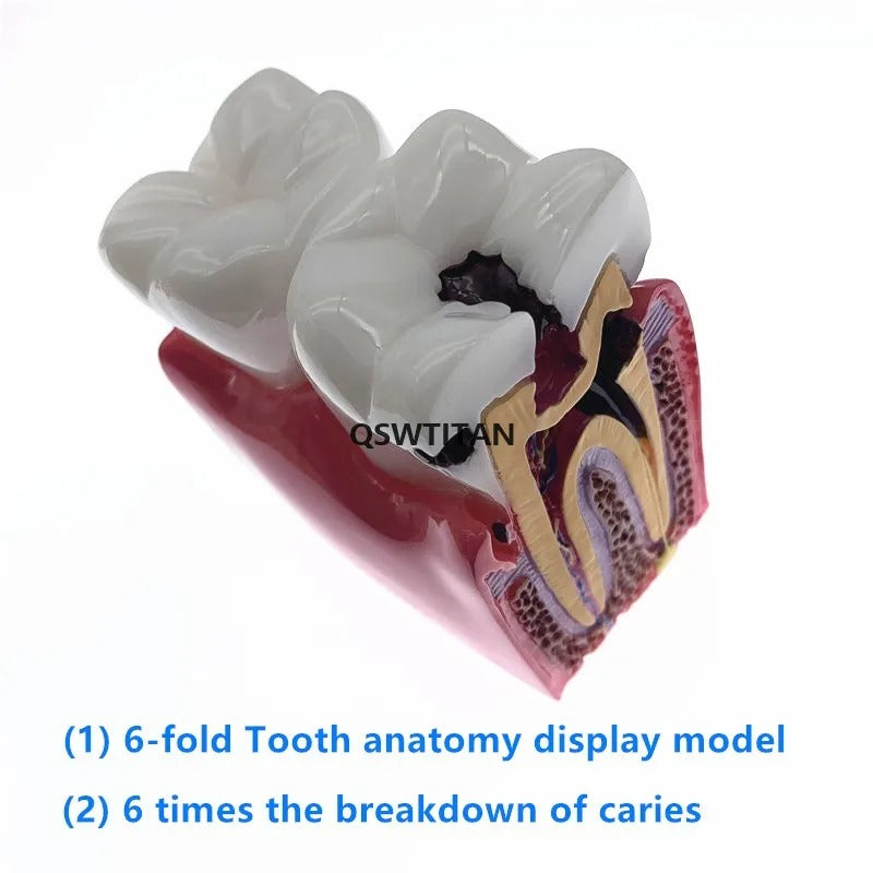 Modelo De Dentes Para Estudantes De Odontologia – Modelo De Cárie