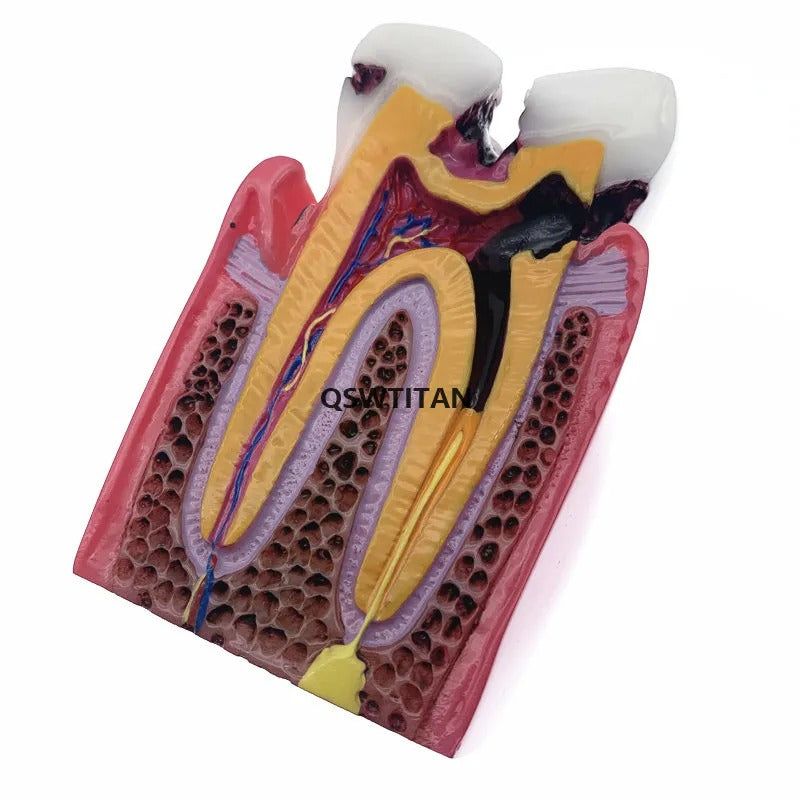 Modelo De Dentes Para Estudantes De Odontologia – Modelo De Cárie