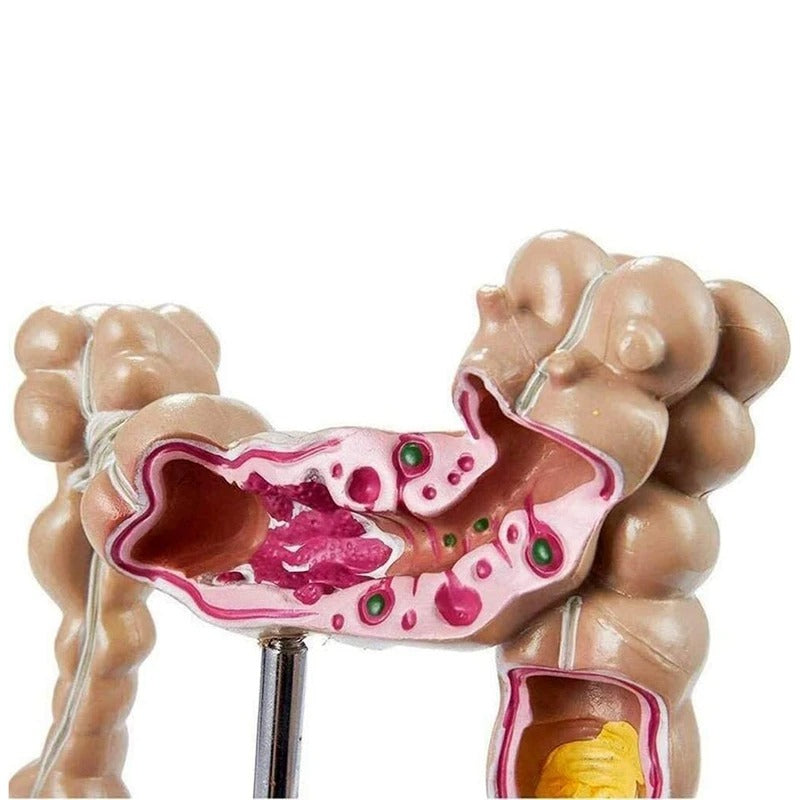 Modelo do Intestino Grande Patológico do Cólon - Câncer Colorretal