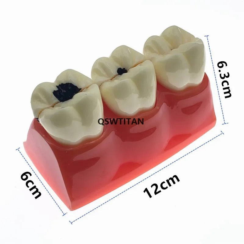 Modelo De Dentes Para Estudantes De Odontologia – Modelo De Cárie