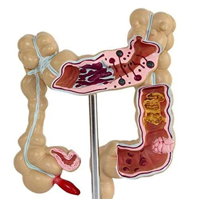 Modelo do Intestino Grande Patológico do Cólon - Câncer Colorretal