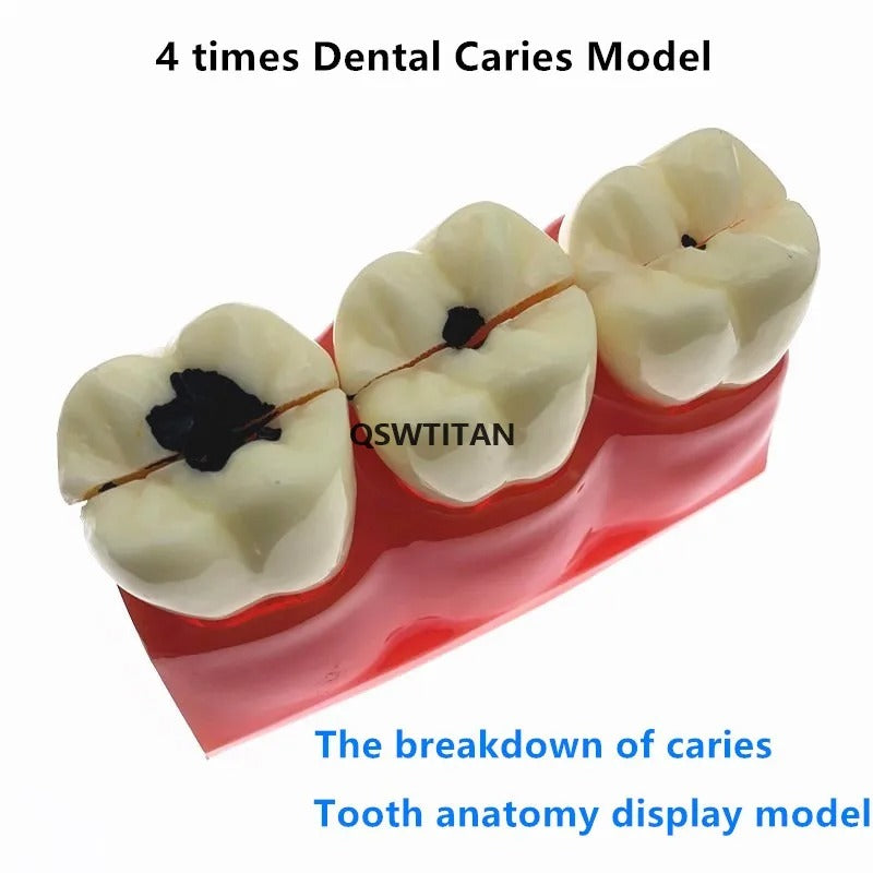 Modelo De Dentes Para Estudantes De Odontologia – Modelo De Cárie