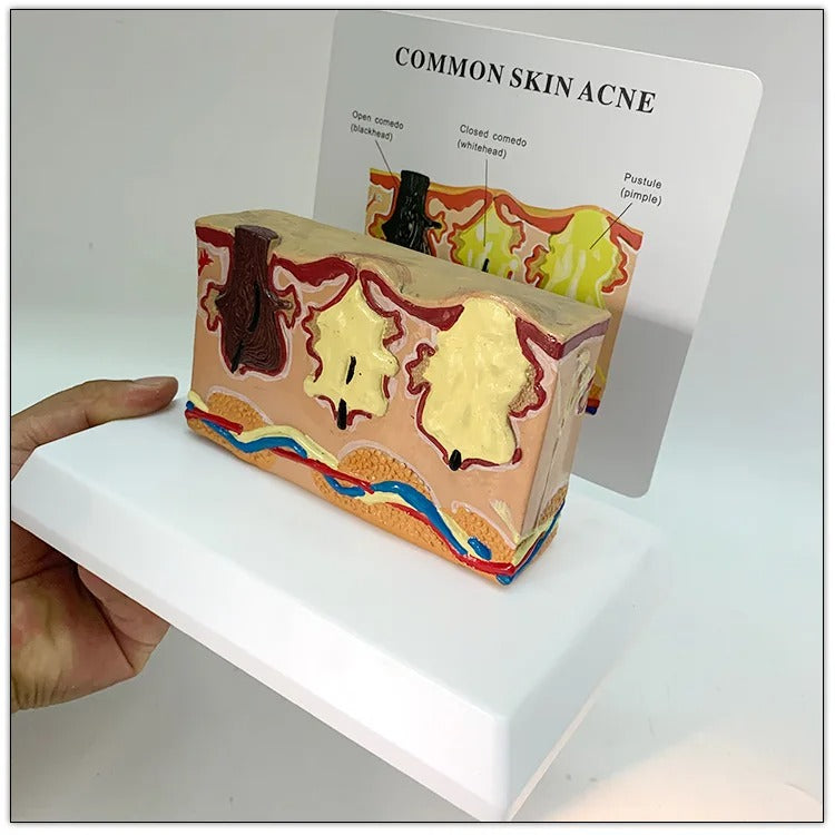 Acne da Pele Comum - Modelo Anatômico Ampliado