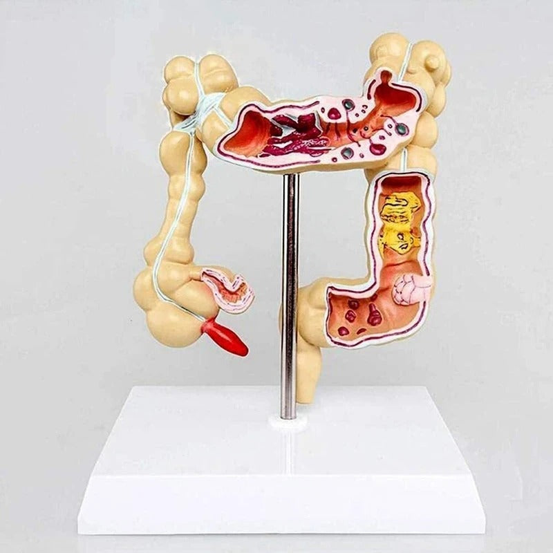 Modelo do Intestino Grande Patológico do Cólon - Câncer Colorretal