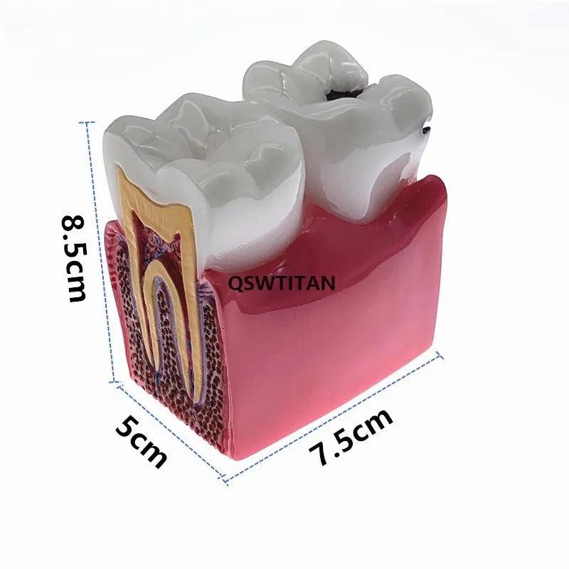 Modelo De Dentes Para Estudantes De Odontologia – Modelo De Cárie