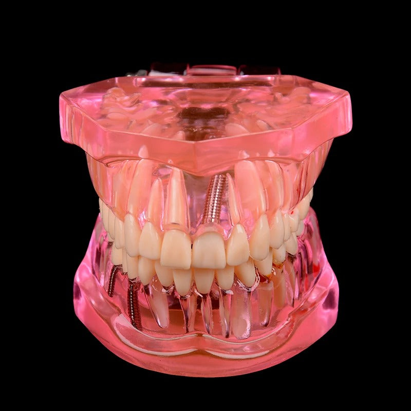 Modelo de Implante Dentário com Ponte de Restauração – Ciência do Dentista