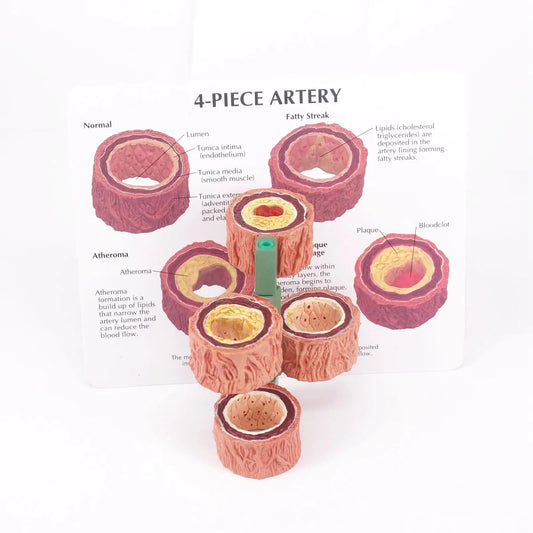 Modelo Anatômico Vascular com 4 Tipos: Normal, gordurosa, Placa e Estenose