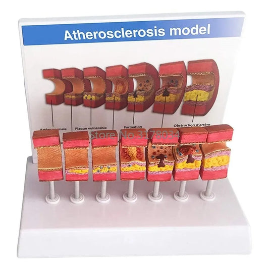 Modelo Anatômico de Artéria Humana com Aterosclerose e Trombo