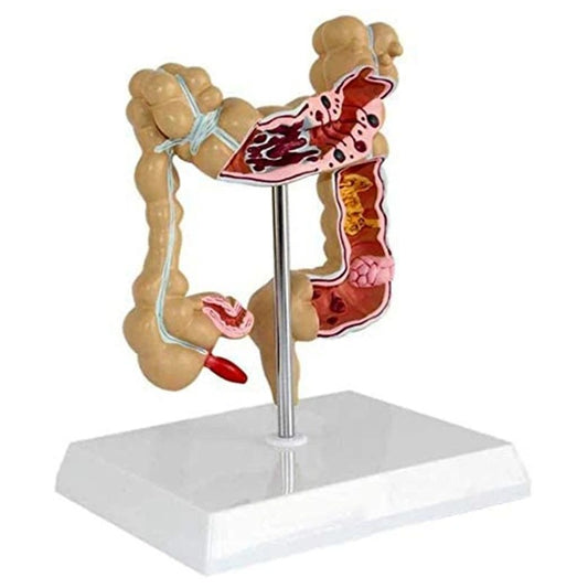 Modelo do Intestino Grande Patológico do Cólon - Câncer Colorretal