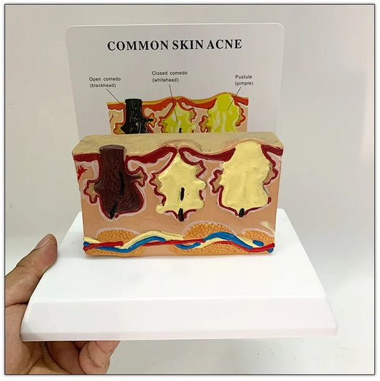Acne da Pele Comum - Modelo Anatômico Ampliado