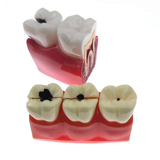 Modelo De Dentes Para Estudantes De Odontologia – Modelo De Cárie