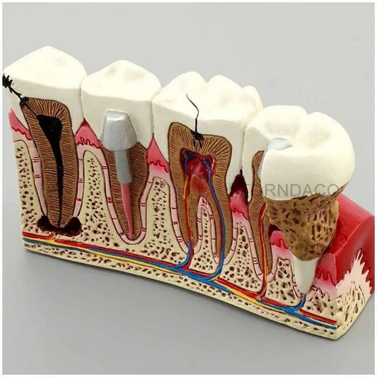 Modelo de Ensino de Anatomia Dentária – Cárie Oral
