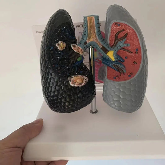 Modelo anatomico pulmao de fumante e saudável