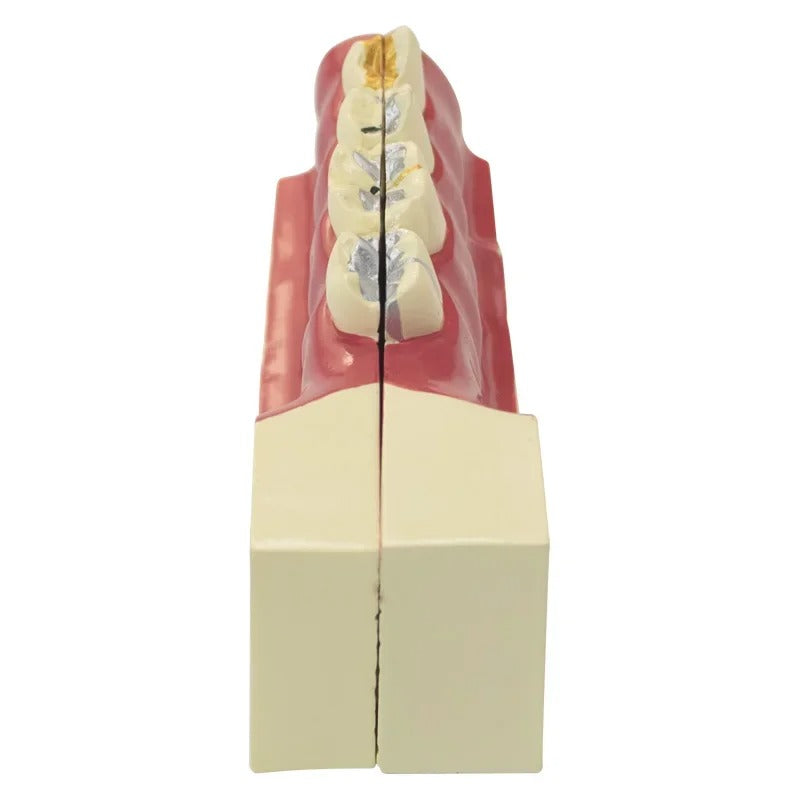 Modelo Dental de reparacao ,Polpa,  e Implante Patológico
