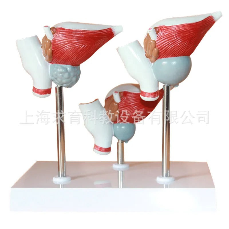 Conjunto de 3 Peças: Modelos de Próstata Normal, Hiperplasia Prostática Benigna (HPB) e Câncer de Próstata