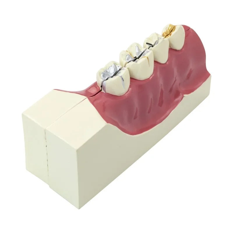Modelo Dental de reparacao ,Polpa,  e Implante Patológico