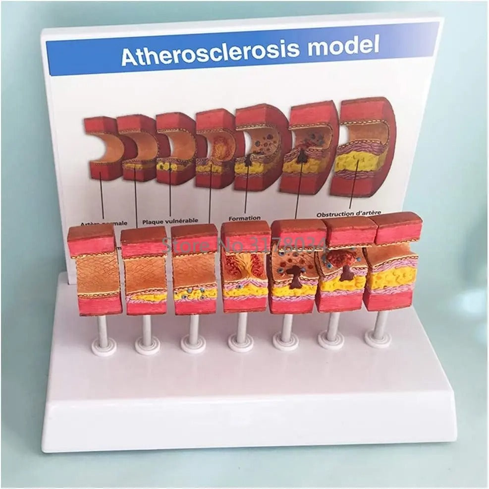 Modelo Anatômico de Artéria Humana com Aterosclerose e Trombo