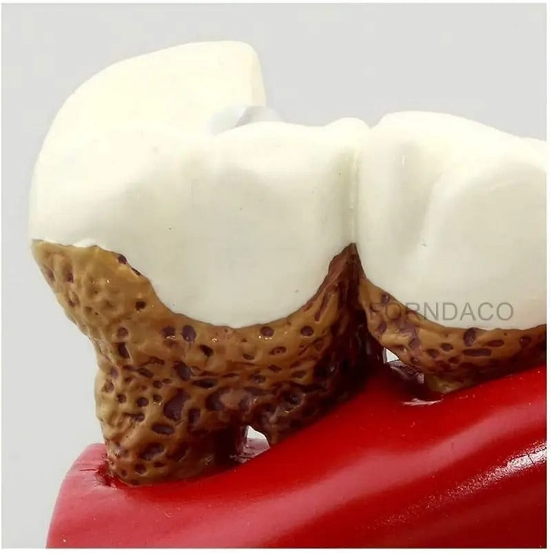 Modelo de Ensino de Anatomia Dentária – Cárie Oral