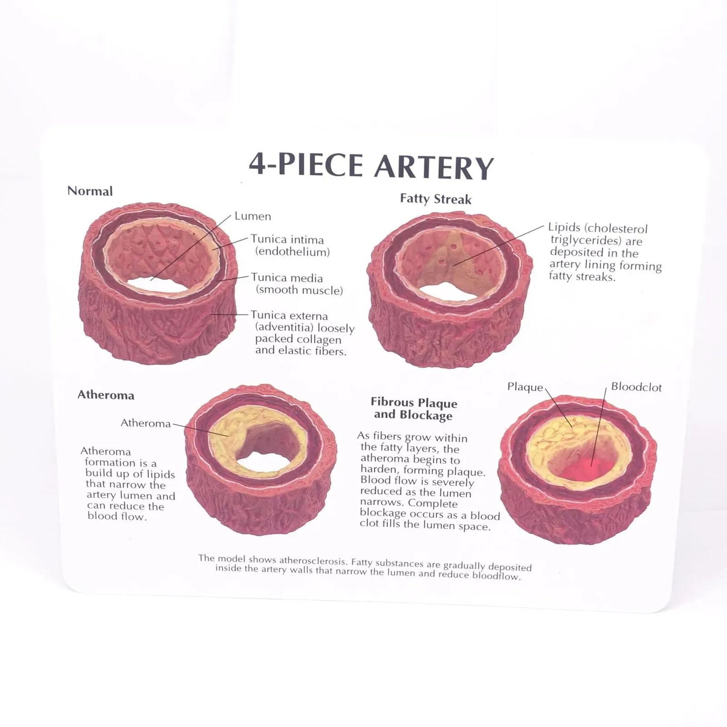 Modelo Anatômico Vascular com 4 Tipos: Normal, gordurosa, Placa e Estenose