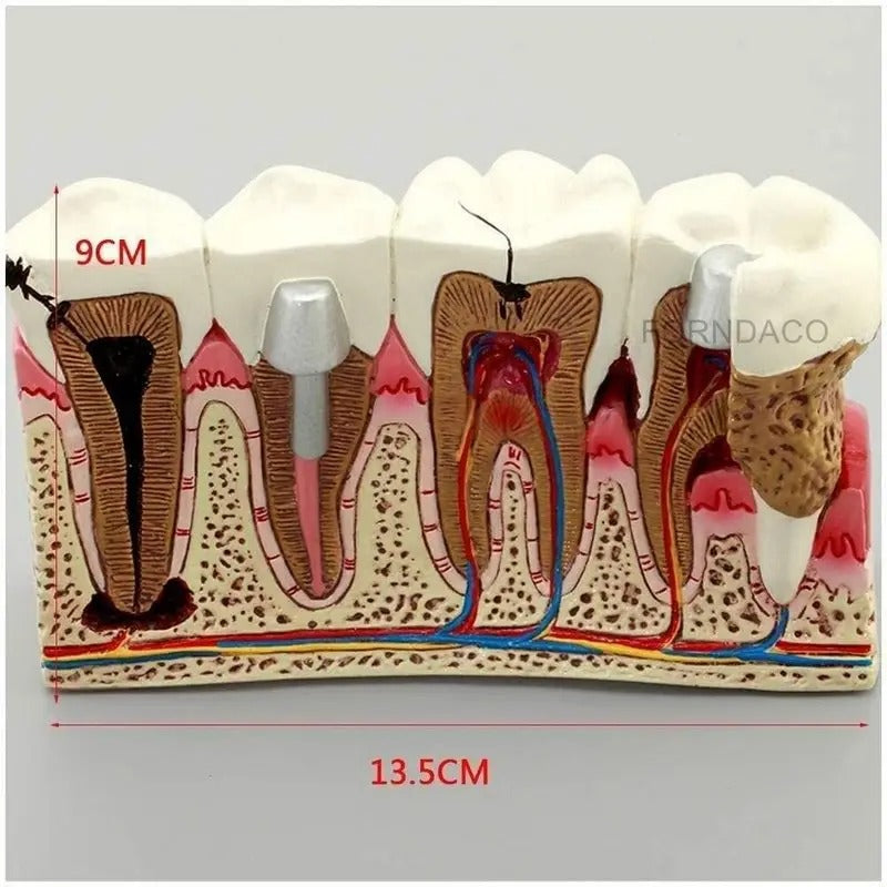 Modelo de Ensino de Anatomia Dentária – Cárie Oral