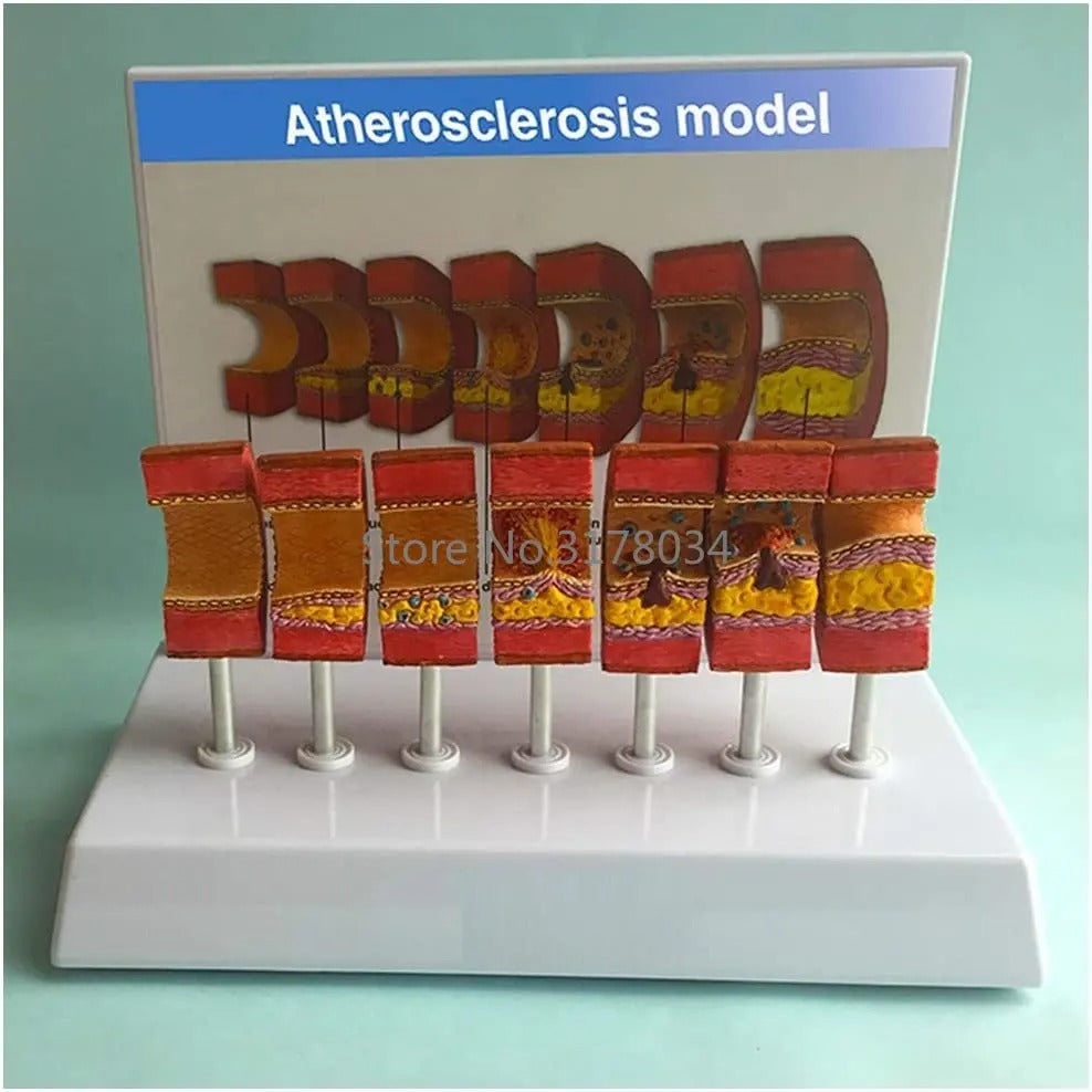 Modelo Anatômico de Artéria Humana com Aterosclerose e Trombo