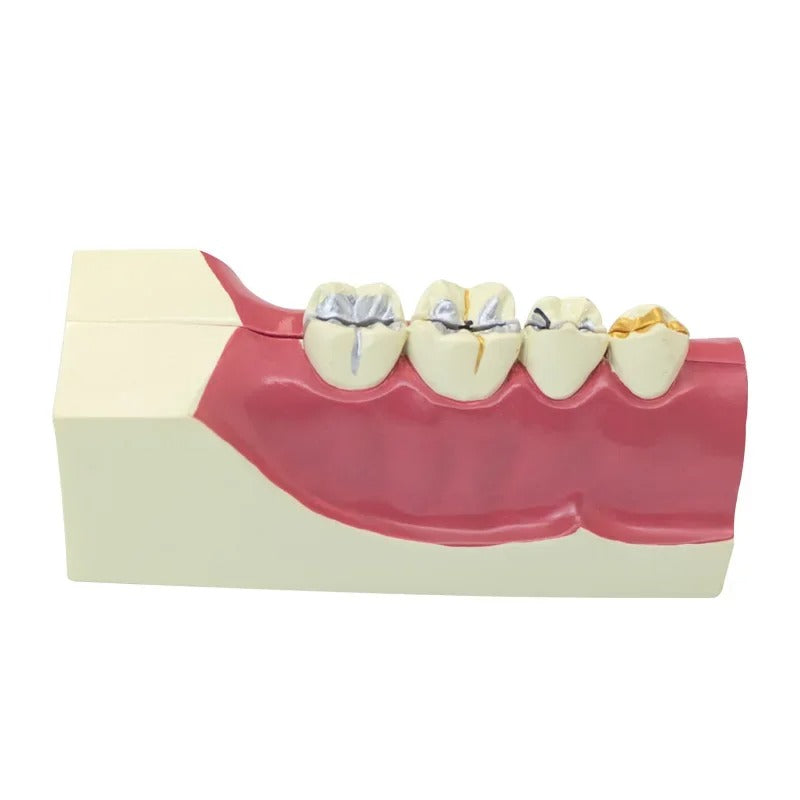 Modelo Dental de reparacao ,Polpa,  e Implante Patológico
