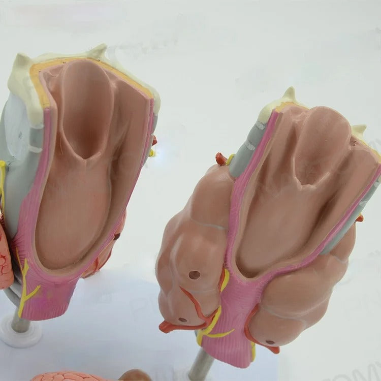 Modelo Anatômico Patologia da Tireóide: Hipertireoidismo