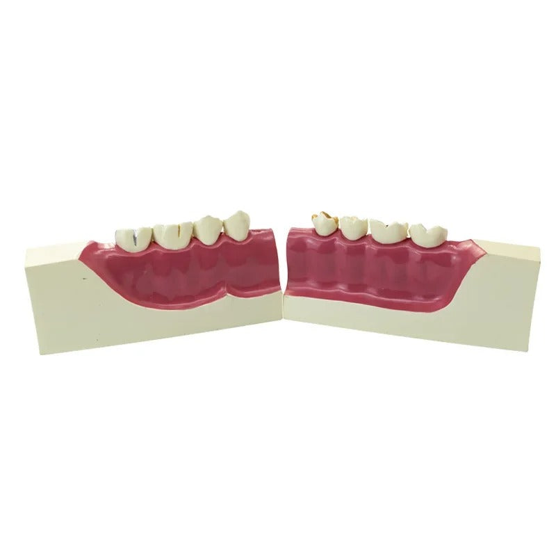 Modelo Dental de reparacao ,Polpa,  e Implante Patológico