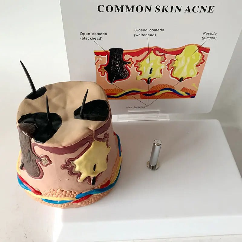 Modelo Anatômico da Estrutura da Pele com Pele Inflamada