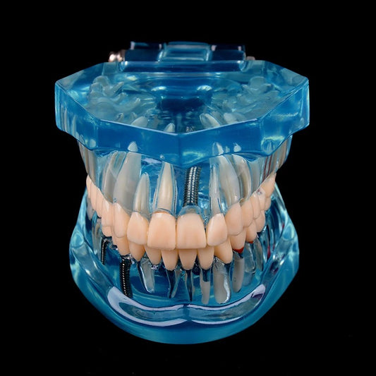 Modelo de Implante Dentário com Ponte de Restauração – Ciência do Dentista